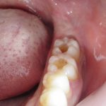 虫歯の時短治療　セレック治療