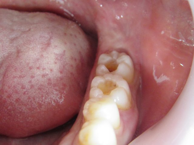 虫歯の時短治療　セレック治療