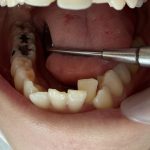 銀歯をセラミックに変える