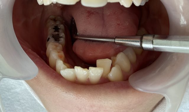 銀歯をセラミックに変える