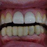 前歯の被せ物の劣化　色の変色