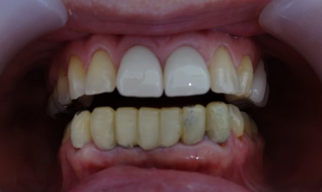 前歯の被せ物の劣化　色の変色