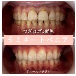 ラミネートベニア🦷✨️ ⁡