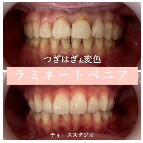 ラミネートベニア🦷✨️ ⁡
