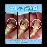 セレック治療