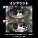 インプラント治療🦷✨️