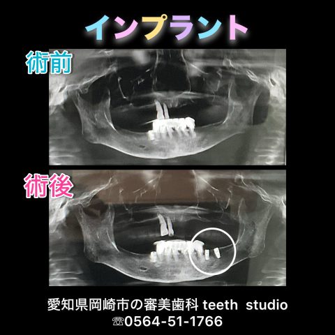 インプラント治療🦷✨️